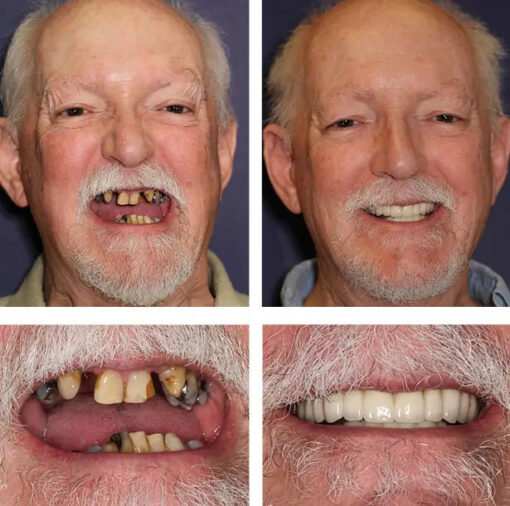 Laozik™ - Advanced Customized Full Denture Set - Image 3