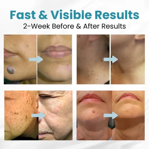 LAOZIK® Non-Invasive Mole and Wart Removal Laser Pen - Image 2