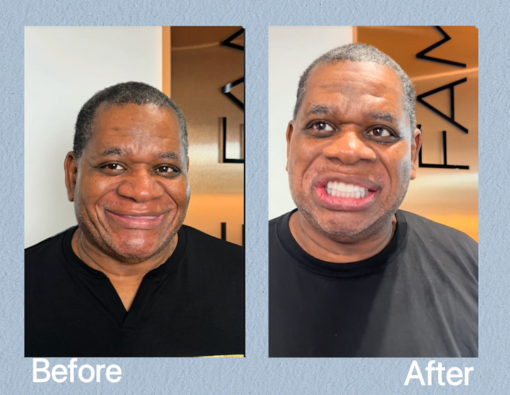 LAOZIK™ - Complete Denture Set - Image 4
