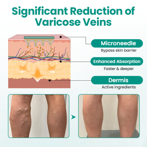 LAOZIK® LegRenew Varicose Veins Patch - Image 2