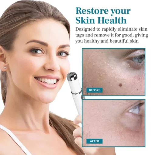 LAOZIK™ FlawZapper Mole and Wart Removal Laser Pen - Image 4